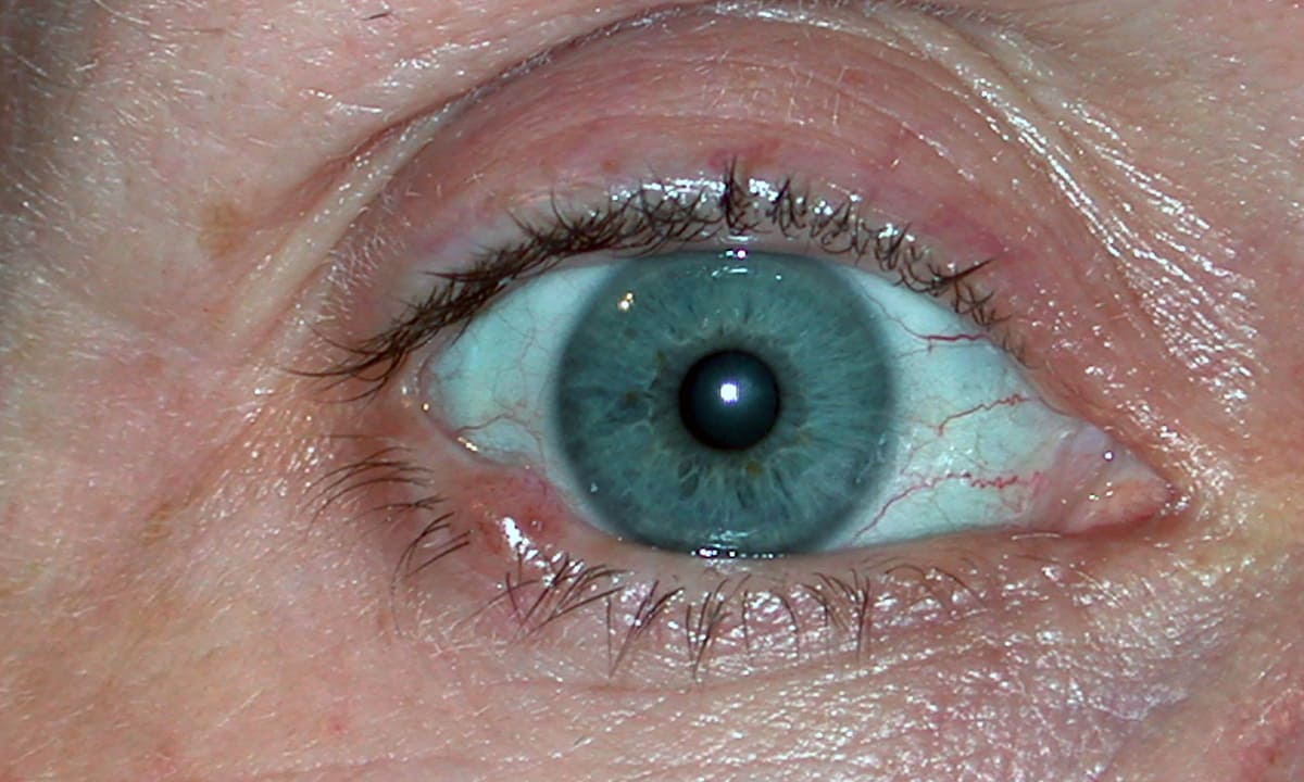 Weißer Hautkrebs Am Unteren Augenlid www.eyefox.com